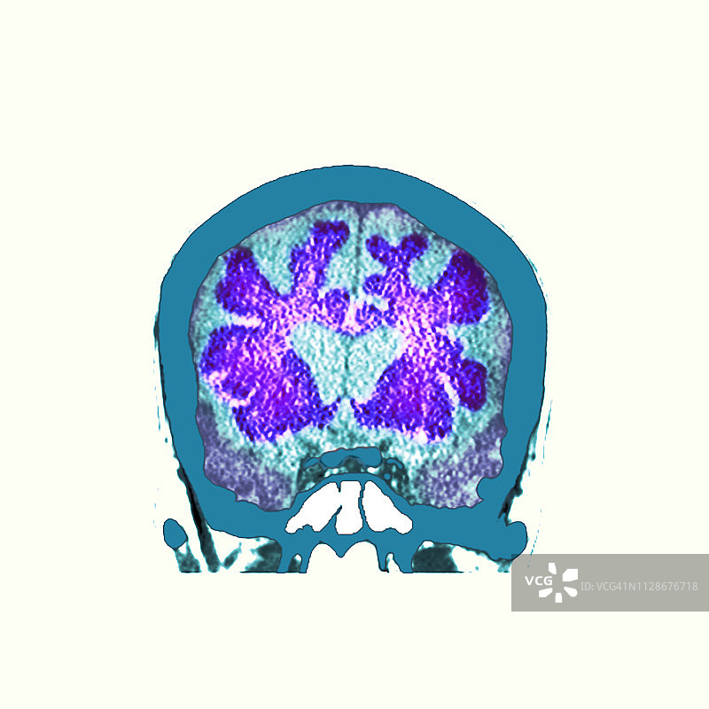 痴呆症大脑CT扫描图片素材
