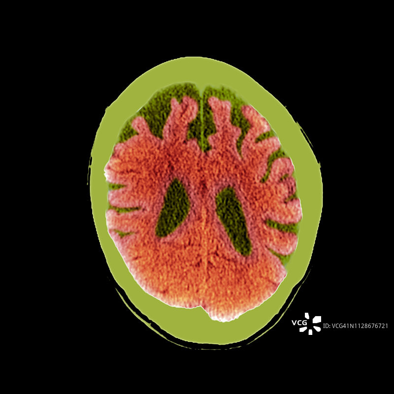 痴呆症大脑CT扫描图片素材