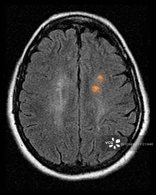 42岁女性多发性硬化症的MRI图片素材