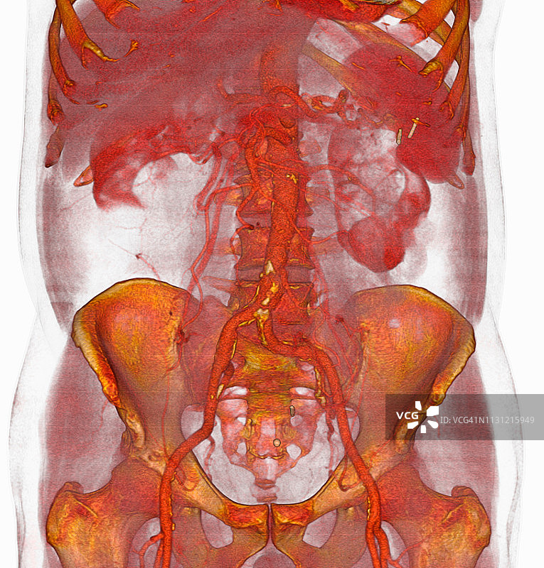 动脉粥样硬化斑块的3D CT扫描，下腹主动脉图片素材