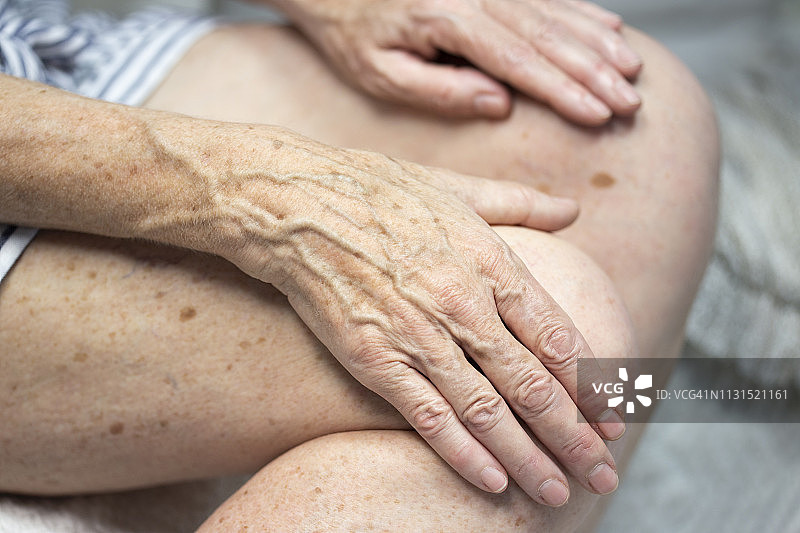 有老年斑的手图片素材