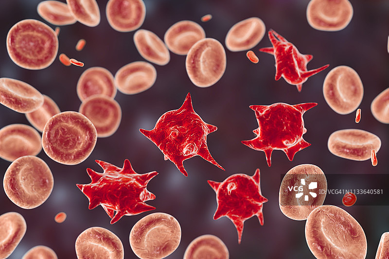 棘细胞异常红细胞，图示图片素材