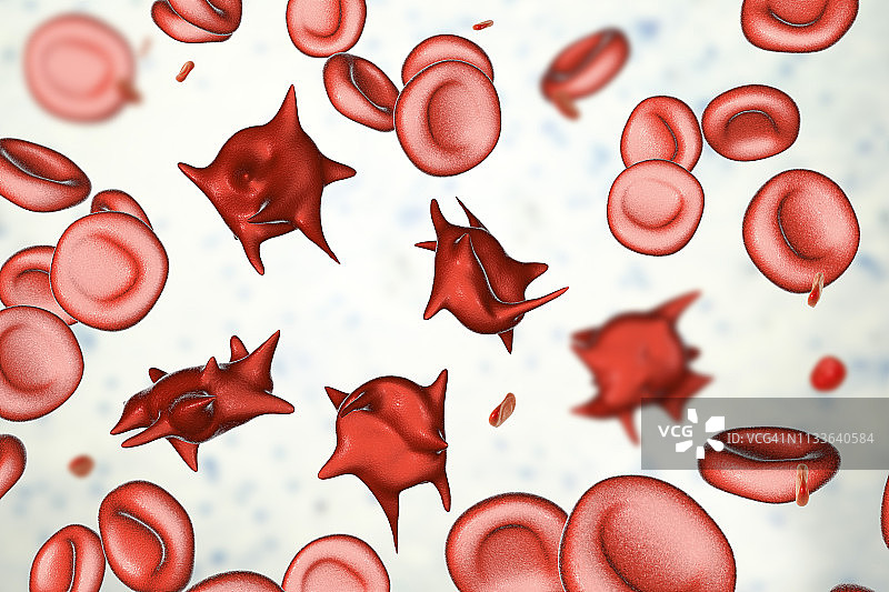 棘细胞异常红细胞，图示图片素材