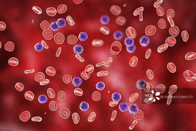 急性淋巴细胞白血病插图图片素材