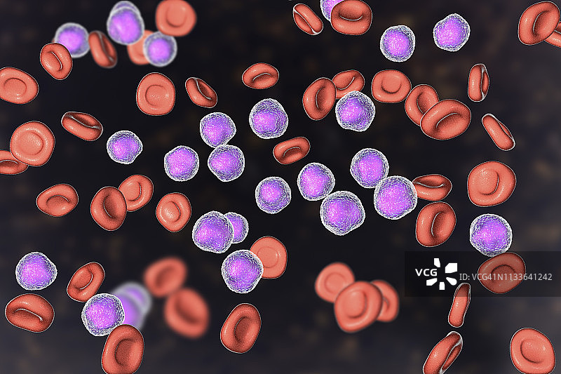 急性淋巴细胞白血病涂片插图图片素材