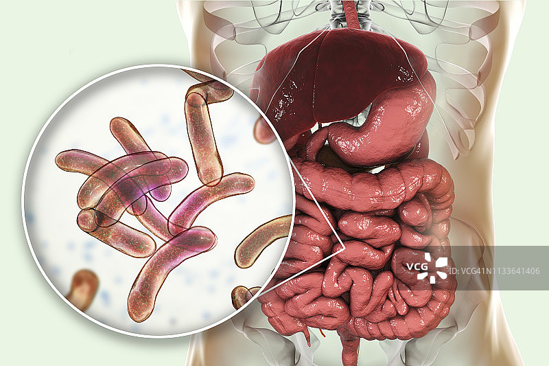 霍乱感染图示图片素材