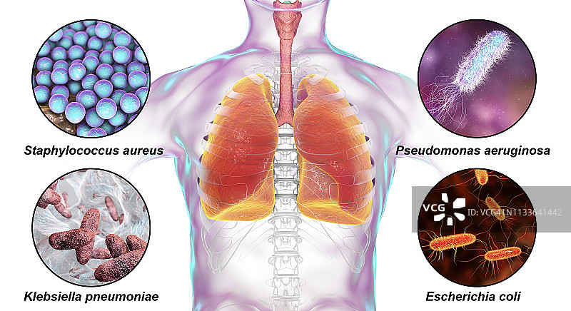 引起医院获得性肺炎的细菌，图示图片素材