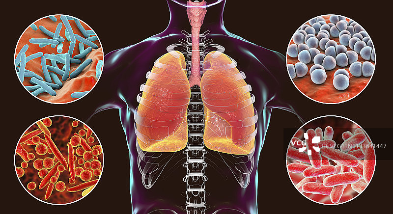 引起肺部感染的细菌图片素材