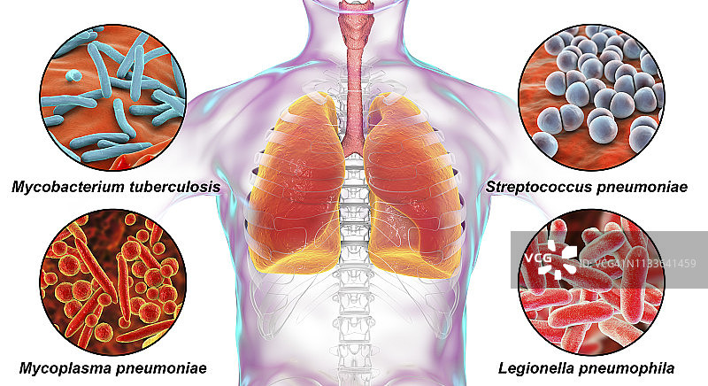 引起肺部感染的细菌图片素材