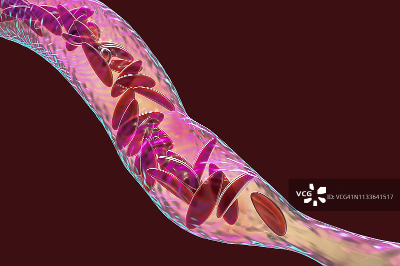 镰状细胞贫血中阻塞的血管插图图片素材