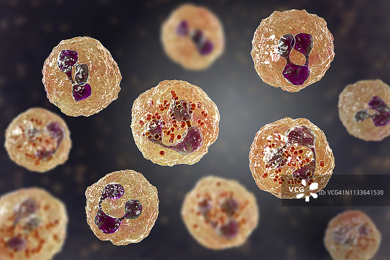 流行性脑脊髓膜炎，图示图片素材