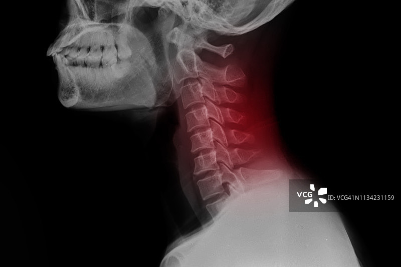 颈部疼痛X光片红色区域图片素材