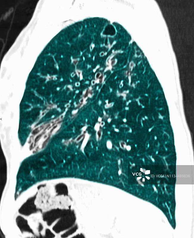 显示囊性纤维化的胸部CT扫描图片素材