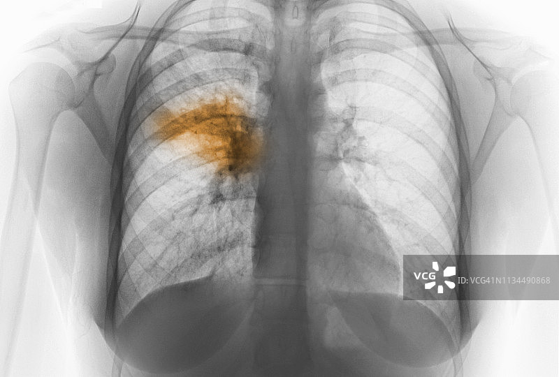 显示肺炎的胸部X光片图片素材