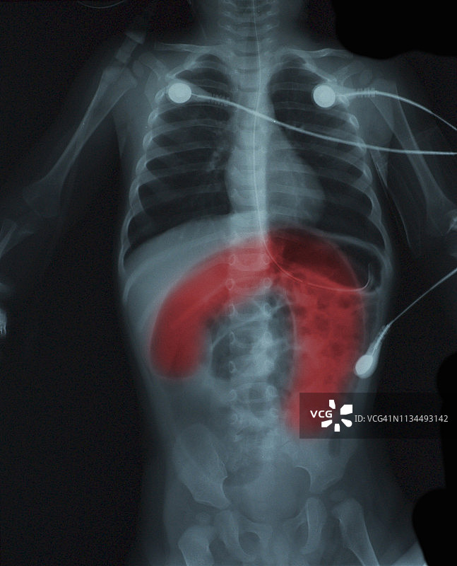 显示先天性巨结肠的X光片图片素材