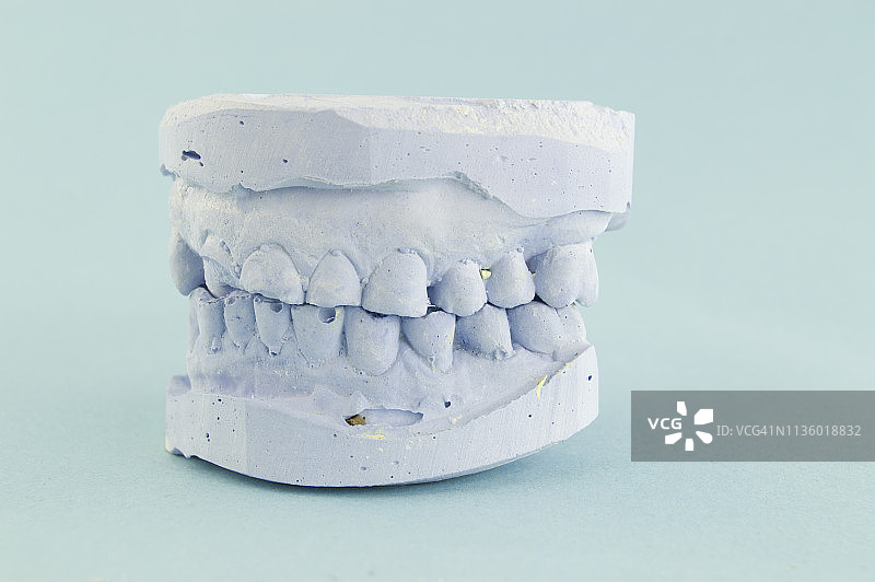 52岁男性患者的牙齿模型图片素材