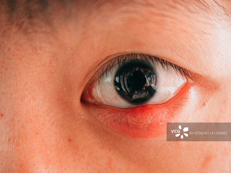 患有麦粒肿的男子图片素材