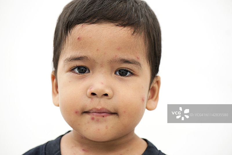 麻疹患儿特写图片素材