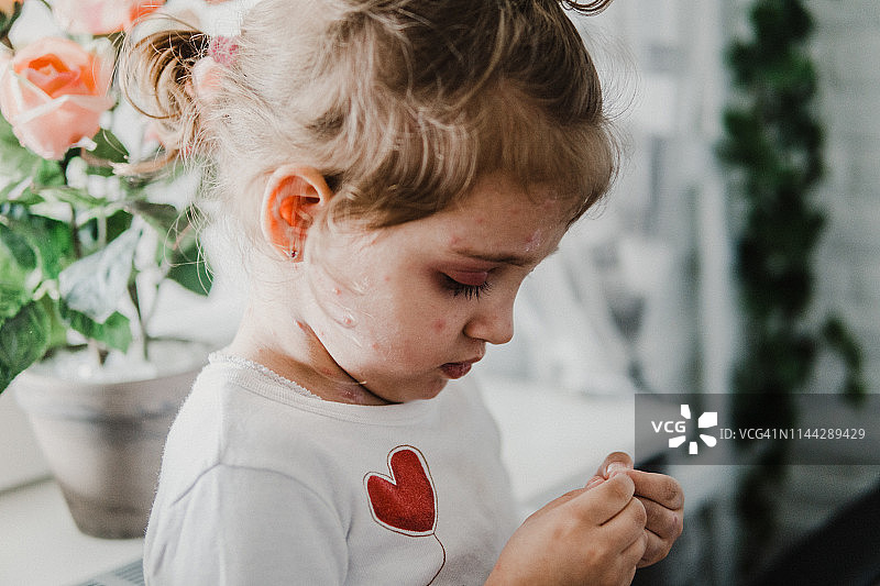 患有水痘的小女孩图片素材