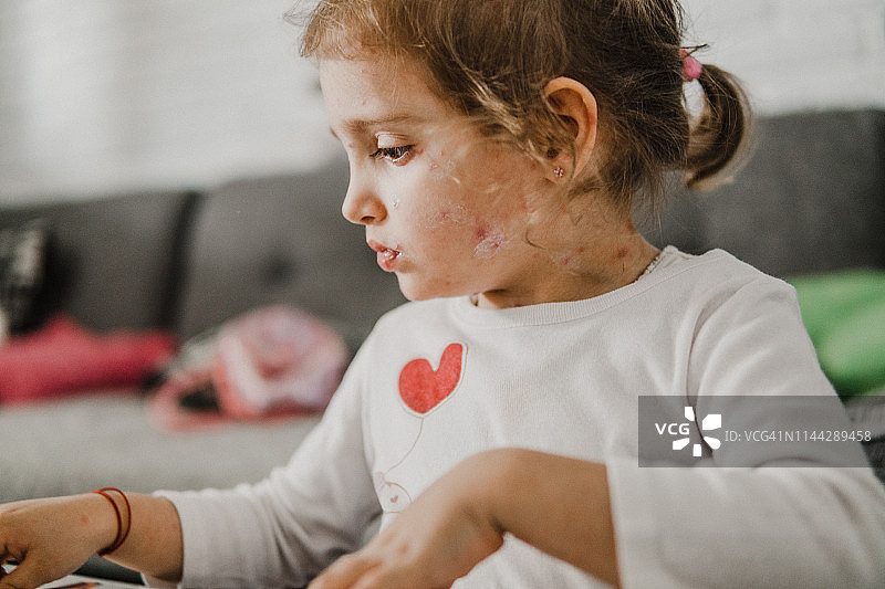患有水痘的小女孩图片素材