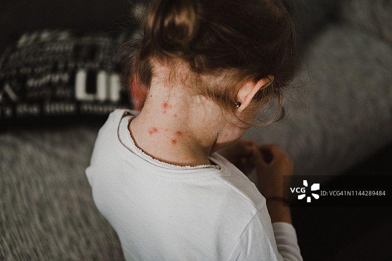 患有水痘的小女孩图片素材