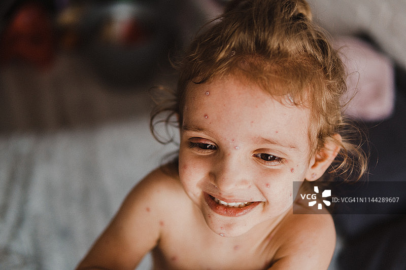 患有水痘的小女孩图片素材