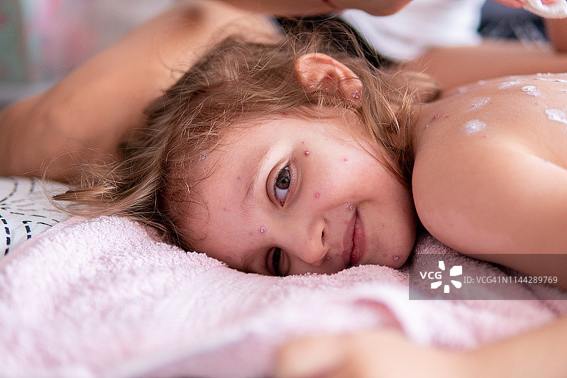 患有水痘的小女孩图片素材