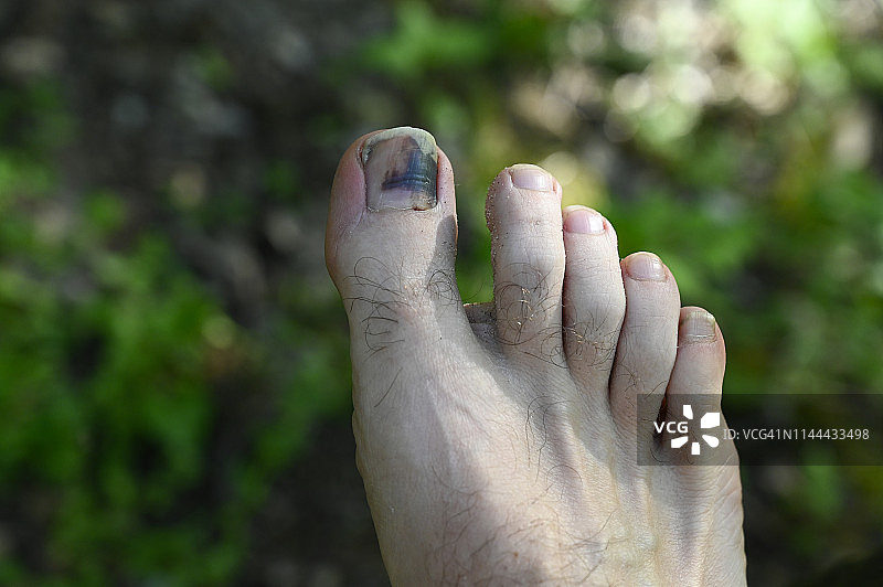 男人因穿小鞋导致脚趾受伤，照片摄于户外绿色草地背景。图片素材
