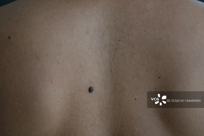 人背部皮肤上有痣的完整画面图片素材
