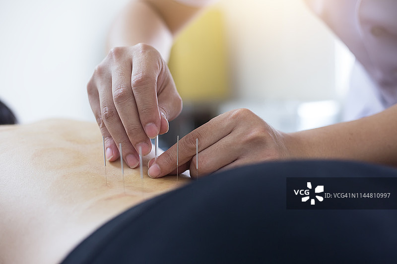 传统中医治疗——针灸图片素材