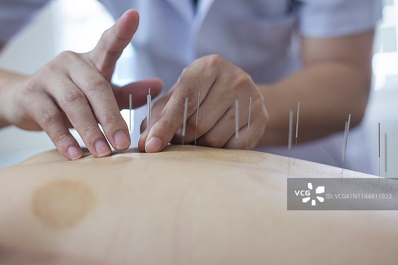 传统中医治疗——针灸图片素材