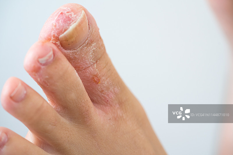 香港脚图片素材