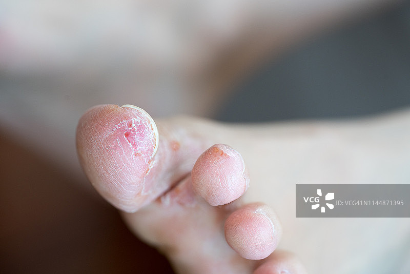 香港脚图片素材