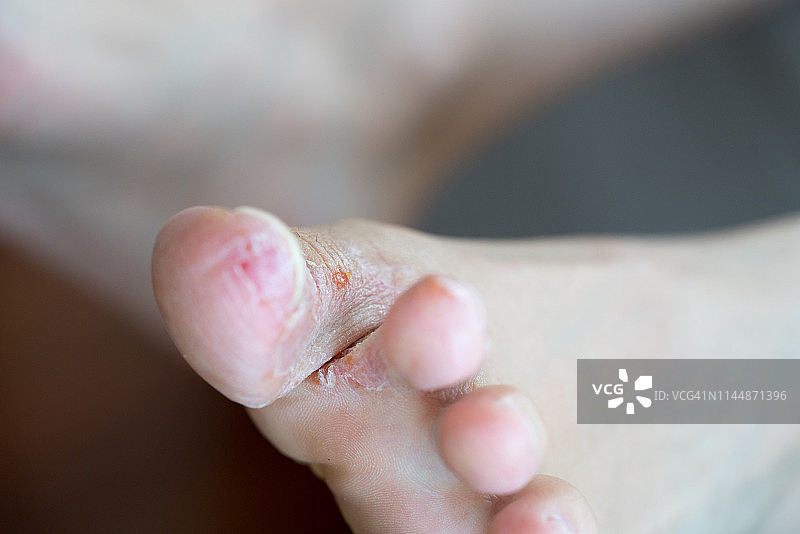 香港脚图片素材