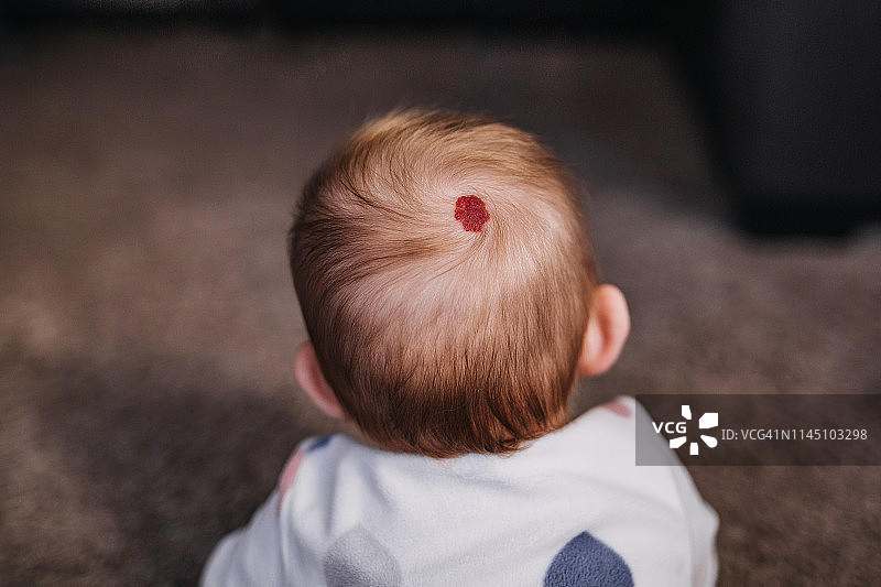 后脑勺有红色胎记的小宝宝图片素材