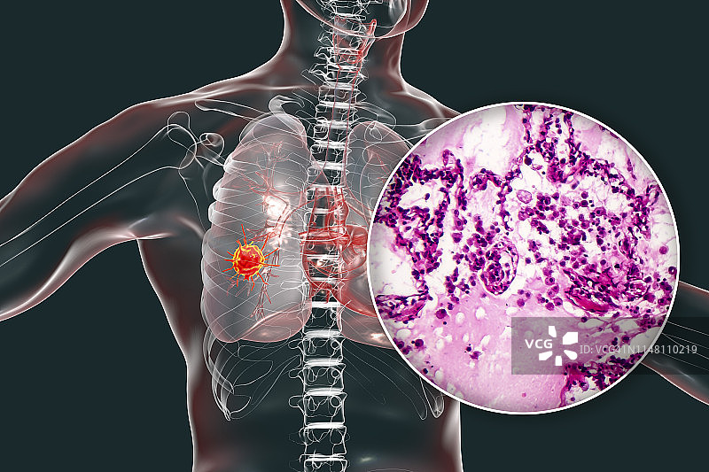 肺癌合成图图片素材