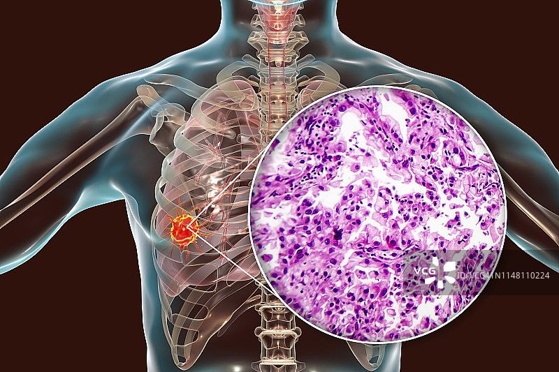 肺癌合成图图片素材