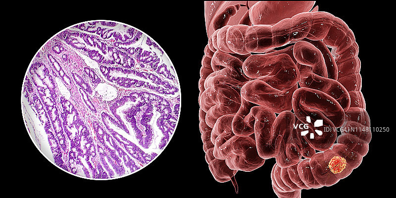 结肠癌合成图图片素材