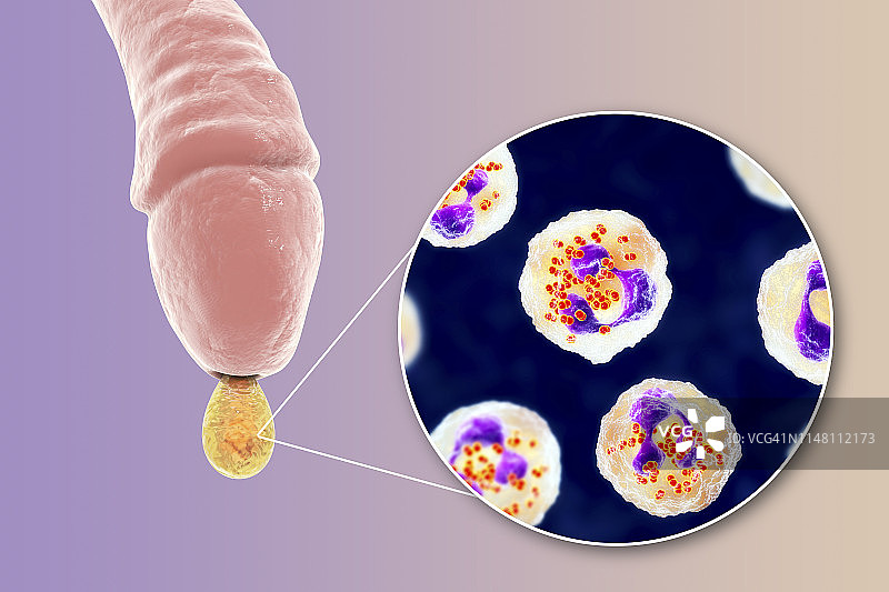 男性淋病感染插图图片素材