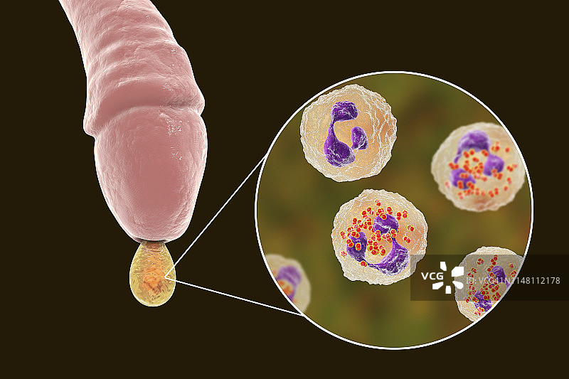 男性淋病感染插图图片素材