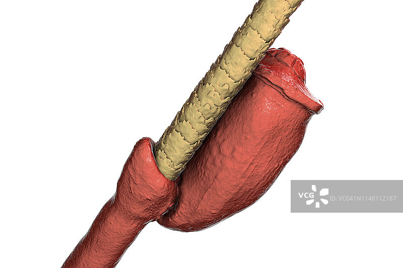头虱卵插画图片素材