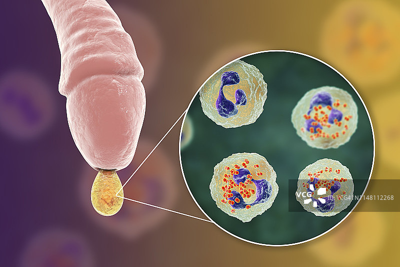 男性淋病感染插图图片素材
