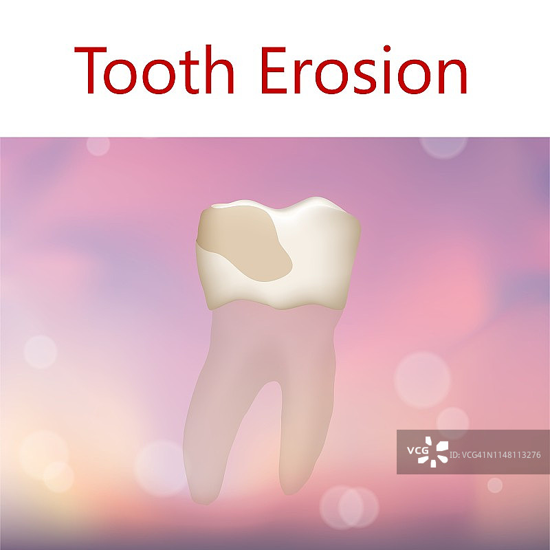 牙齿腐蚀插图图片素材