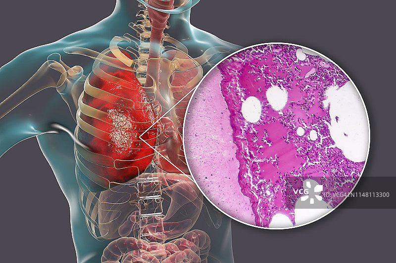 大叶性肺炎，图示和光学显微镜照片图片素材