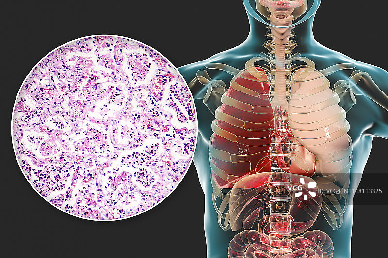 大叶性肺炎，图示和光学显微镜照片图片素材