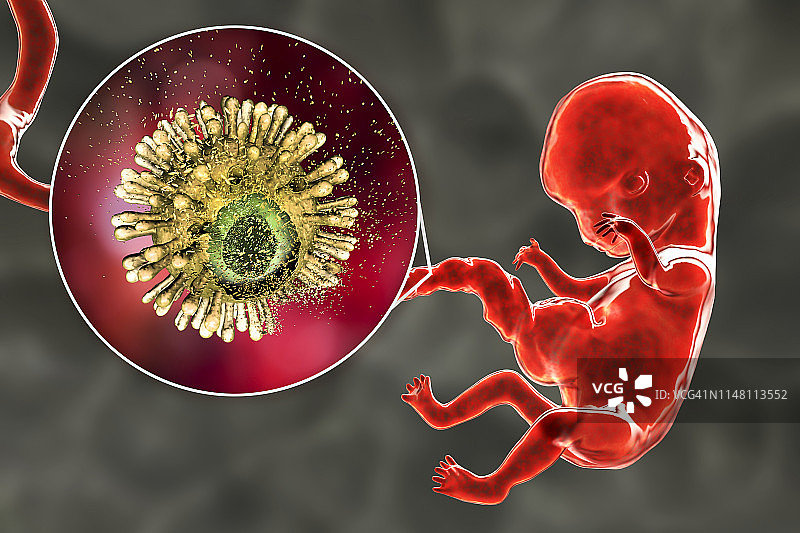 阻止HIV经胎盘传播示意图图片素材