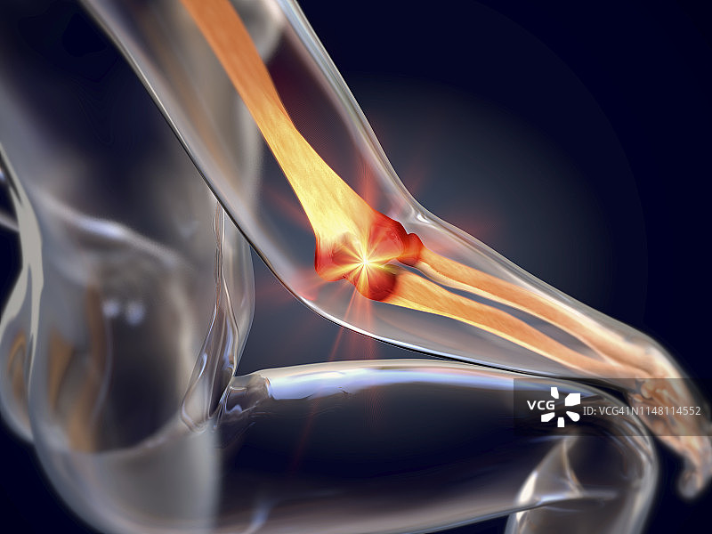 网球肘插画图片素材