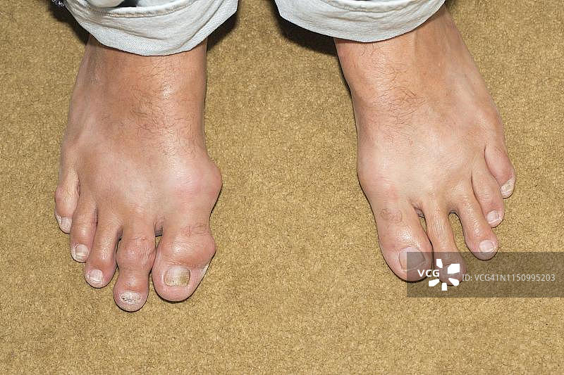 患有痛风的男性脚部，德国图片素材