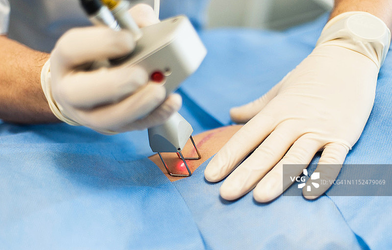 医生用激光修复皮肤疤痕图片素材