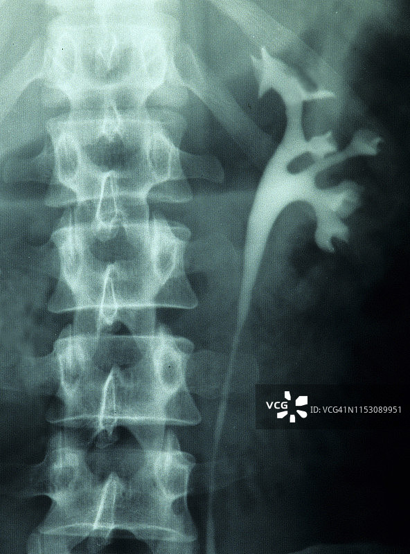 肾脏解剖结构：肾盂、肾盏和输尿管，X光片，静脉肾盂造影图片素材